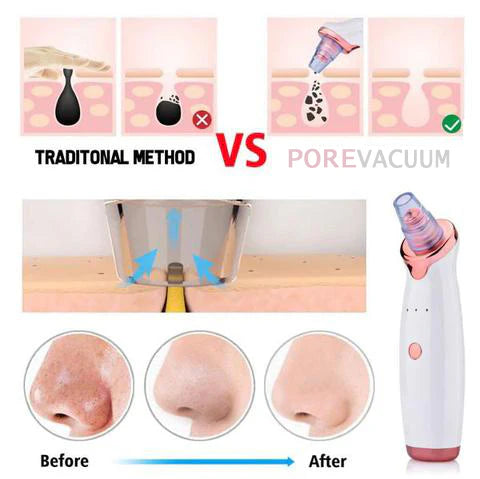 Electric Blackhead Remover Pore Vacuum –  Facial Cleaner