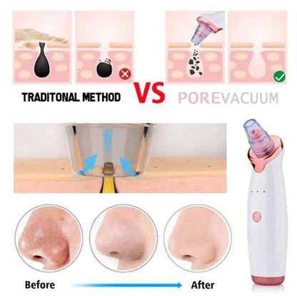 Electric Blackhead Remover Pore Vacuum –  Facial Cleaner